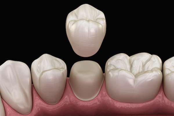 What To Ask Your General Dentist When Preparing for a Crown from Sandston Comprehensive Dentistry in Sandston, VA