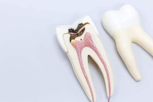 Ask a General Dentist: Is a Tooth Dead After a Root Canal from Sandston Comprehensive Dentistry in Sandston, VA