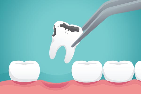 Ask a General Dentist: What Happens to Your Tooth After Extraction from Sandston Comprehensive Dentistry in Sandston, VA