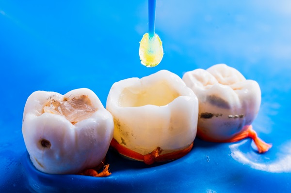 Before And After Your Dental Bonding Procedure