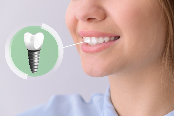 How Long Does It Take To Heal From Dental Implant Placement?