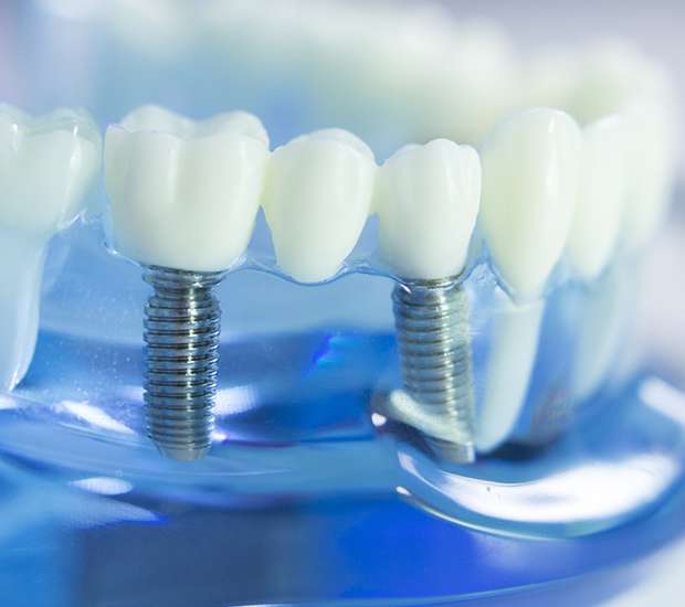 Sandston Dental Implants