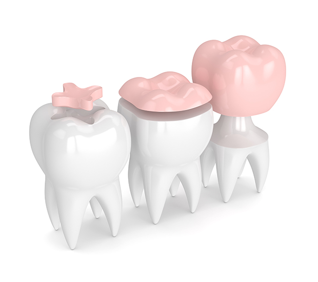 Sandston Dental Inlays and Onlays