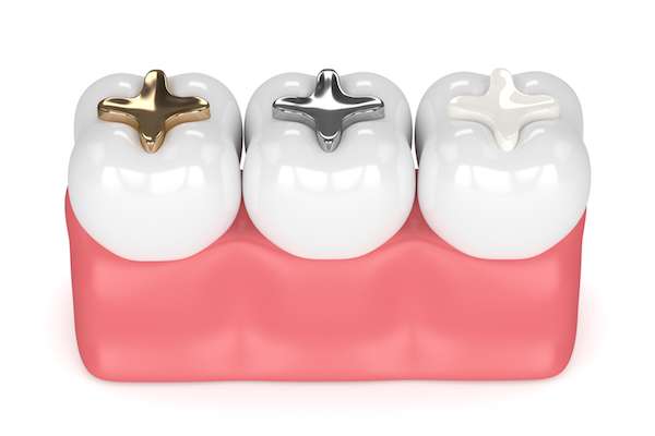 What are the Pros and Cons of Undergoing Dental Tooth Filling? - Elite  Dental Care