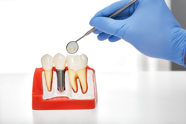 Questions To Ask A Dentist About Implant Crowns